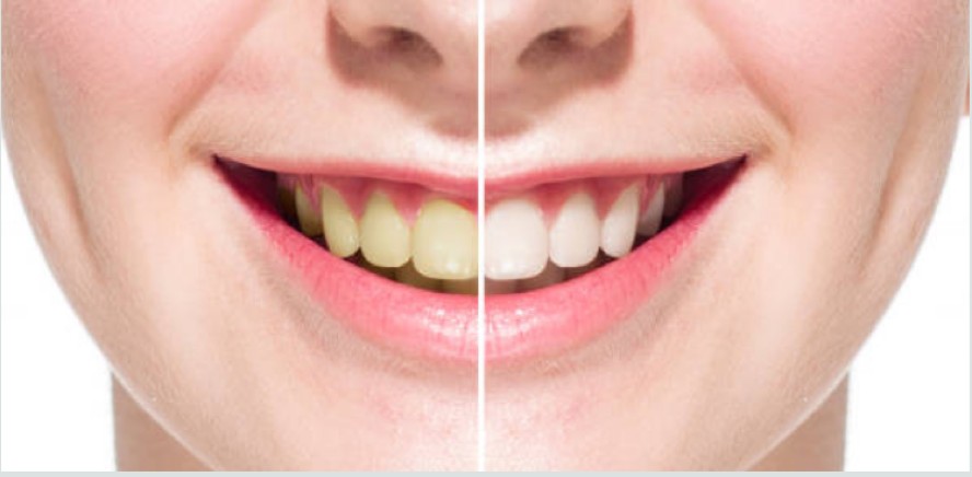 How Often Should You Get Teeth Whitening
